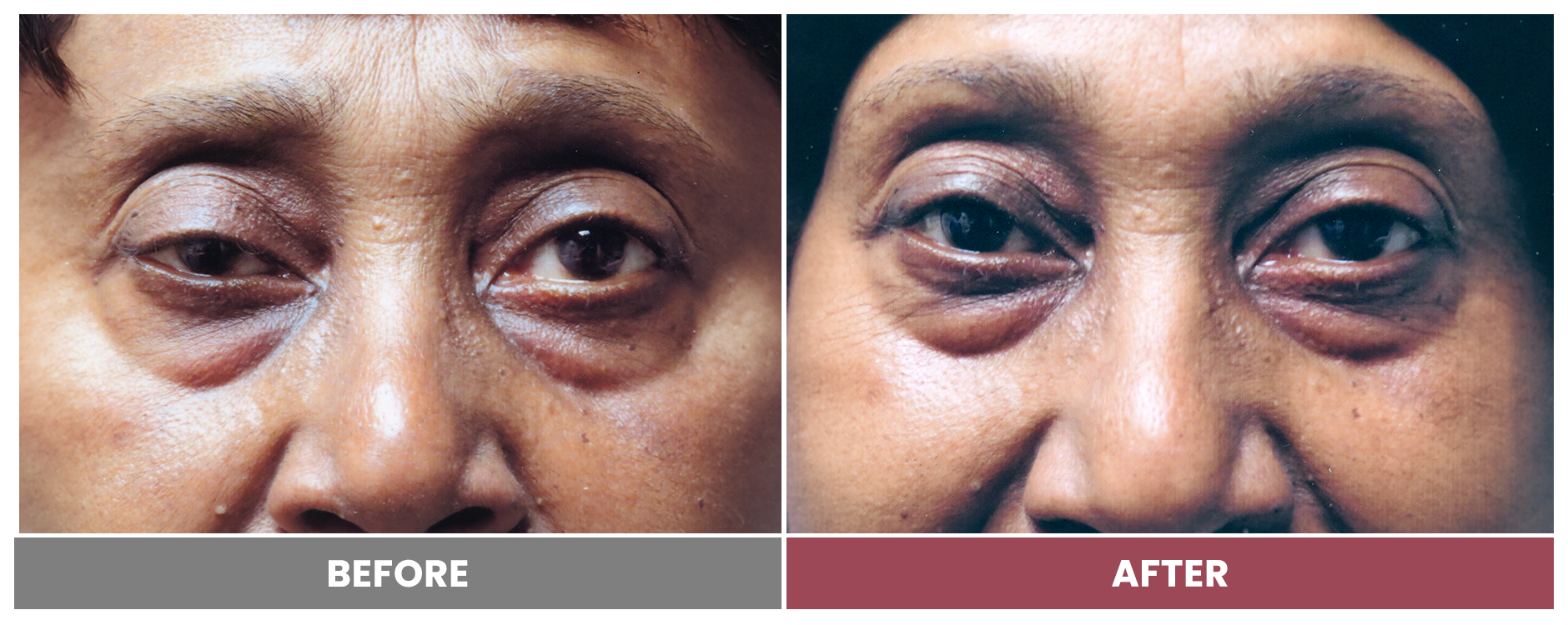 PTOSIS REPAIR - Case 28